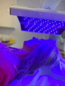 led lichttherapie tegen acne