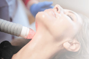 needling met RF